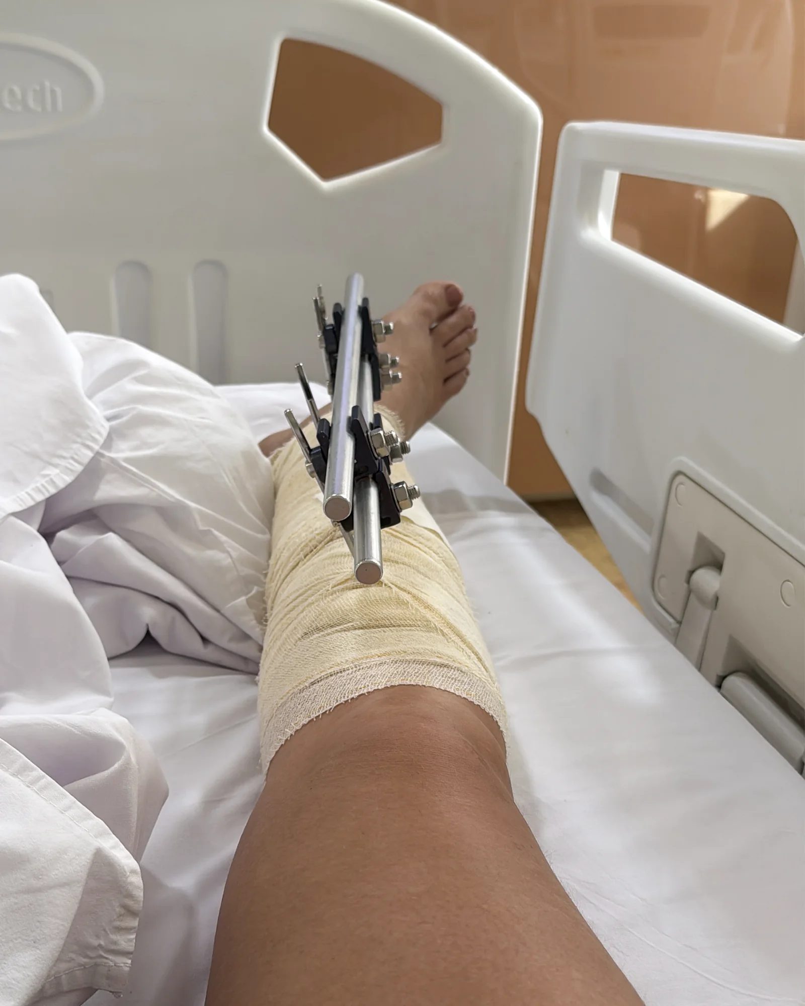 Registro hospitalar de um imprevisto ortopédico na reta final